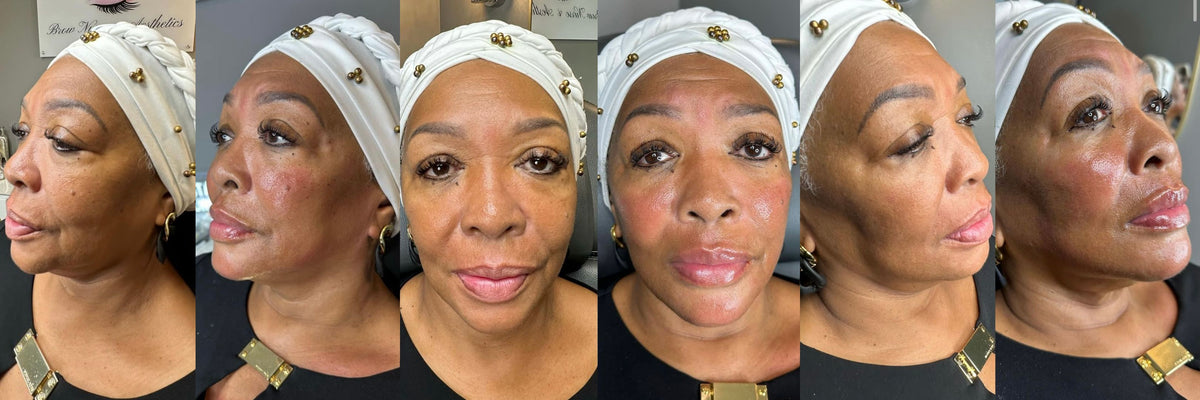 Omnifiller Program Filler – Omni Medspa
