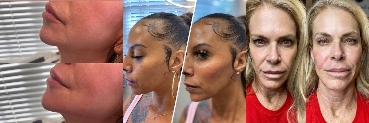 Omnifiller Program Filler – Omni Medspa