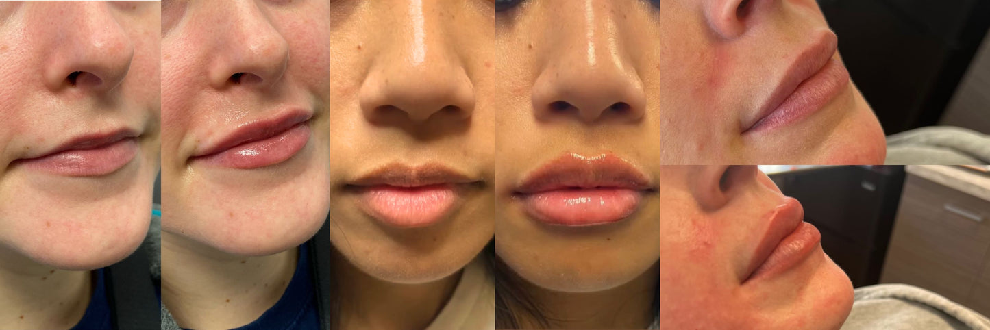 Omnifiller Program Filler – Omni Medspa